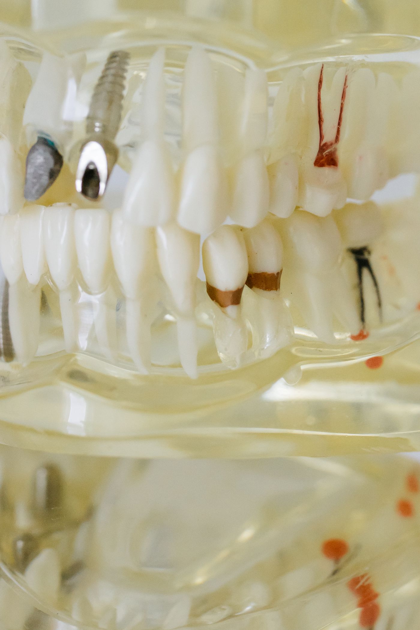 Dental Implants